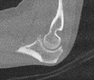 Coronoid Fracture Type 1 CT